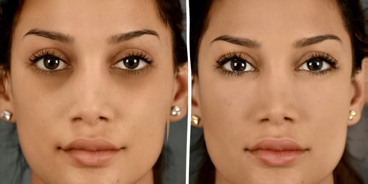 Under Eye Filler Injections in Dubai Longevity Guide