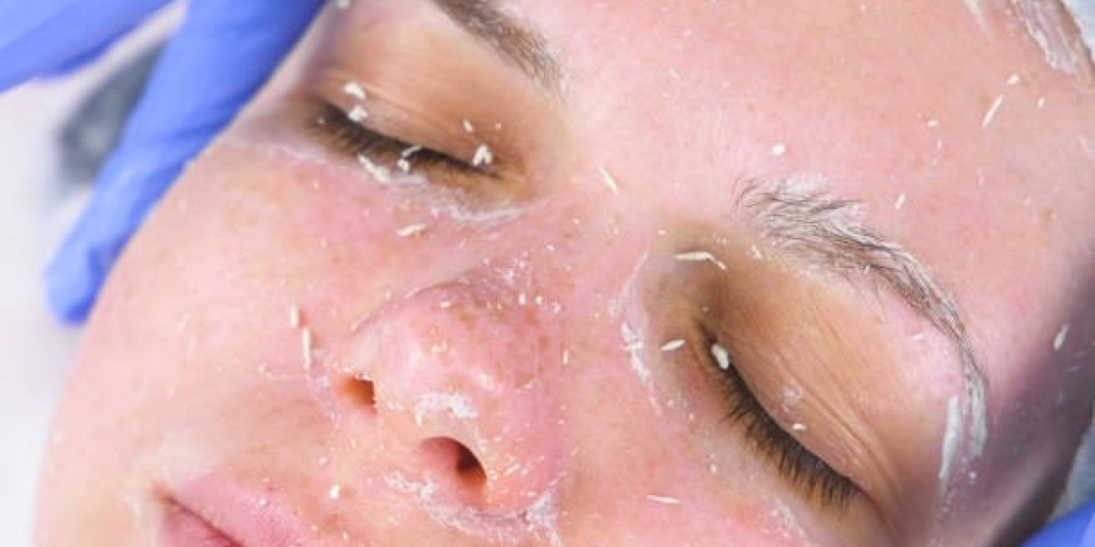 Cosmelan Peel in Dubai for Acne Scars and Dark Marks