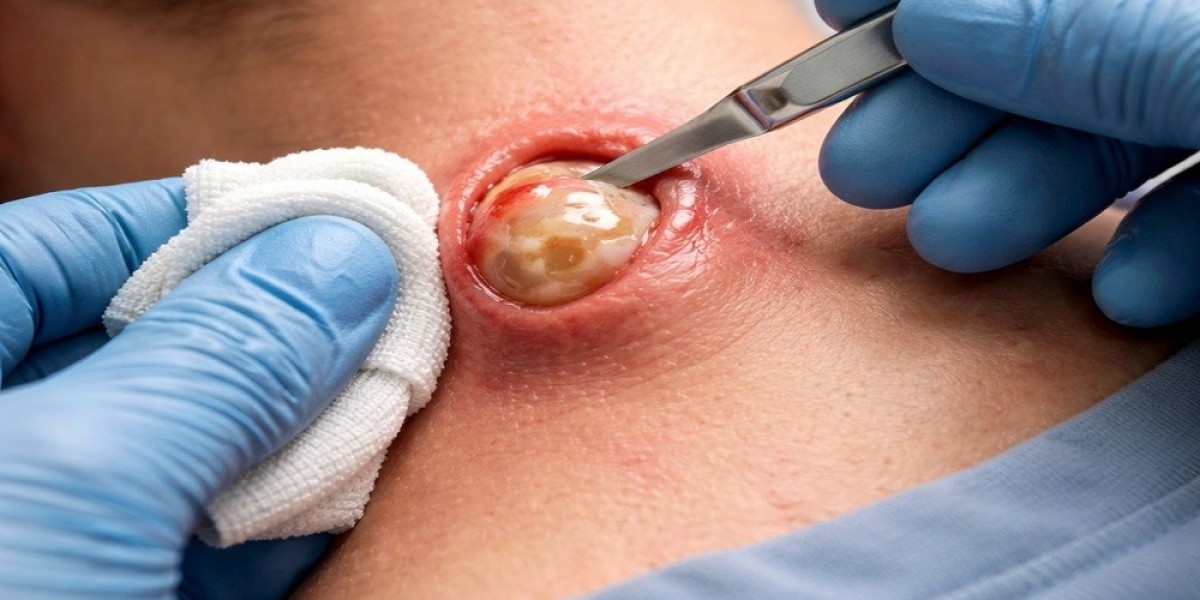 Personalized Mole Removal Treatments in Islamabad – Here’s Why