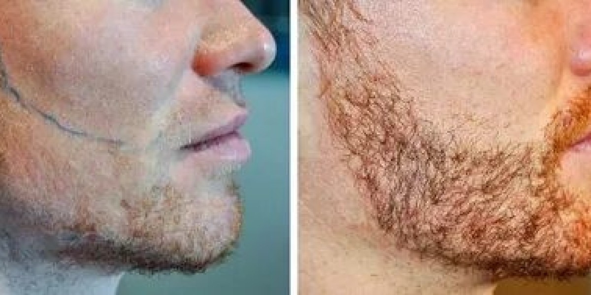 PRP Beard Growth Treatment and Natural Hair Stimulation Process