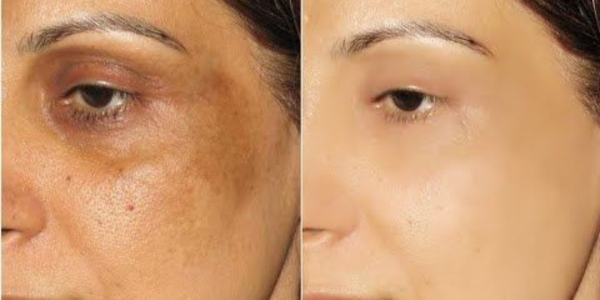 Skin Pigmentation in Dubai: Even Tone Solutions