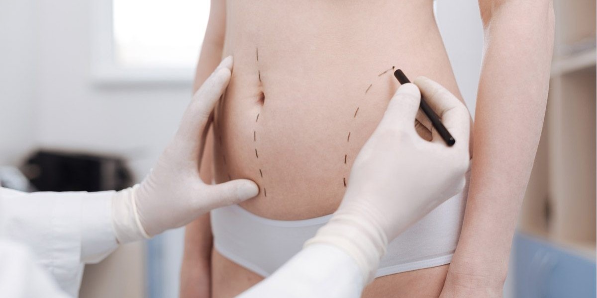 Top Specialists: Best Doctors in Dubai for Liposuction Revealed