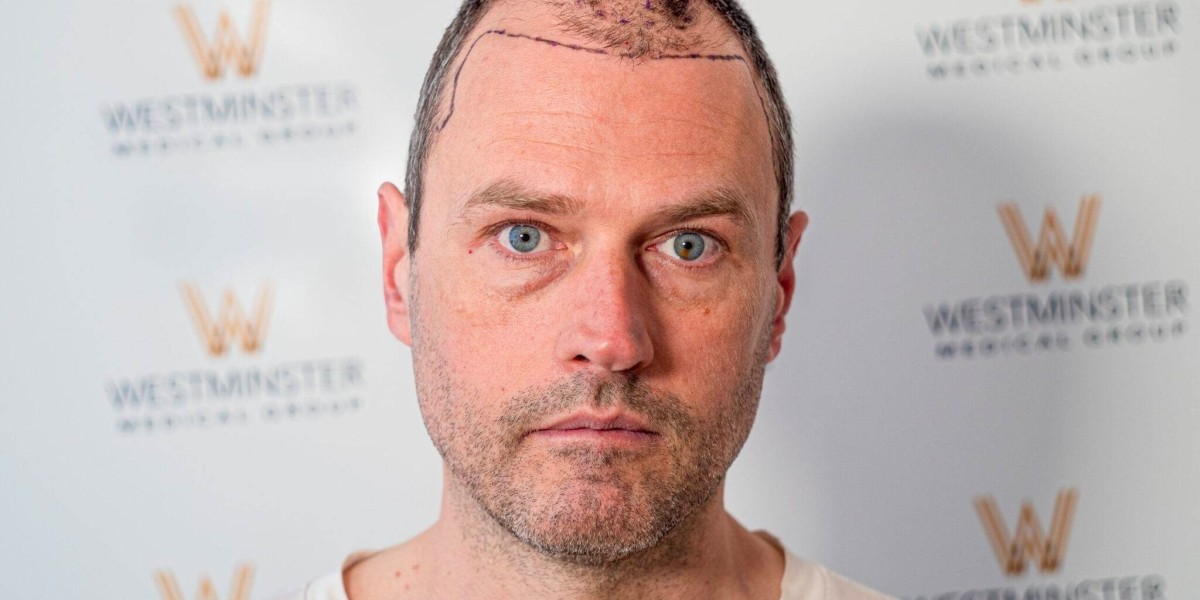Best Hair Transplant UK: Long-Term Results and Maintenance