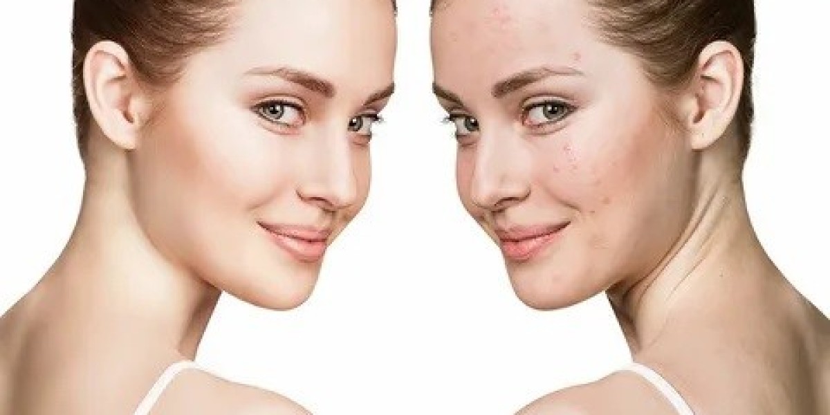 Laser Acne Therapy in Islamabad: Benefits and Costs