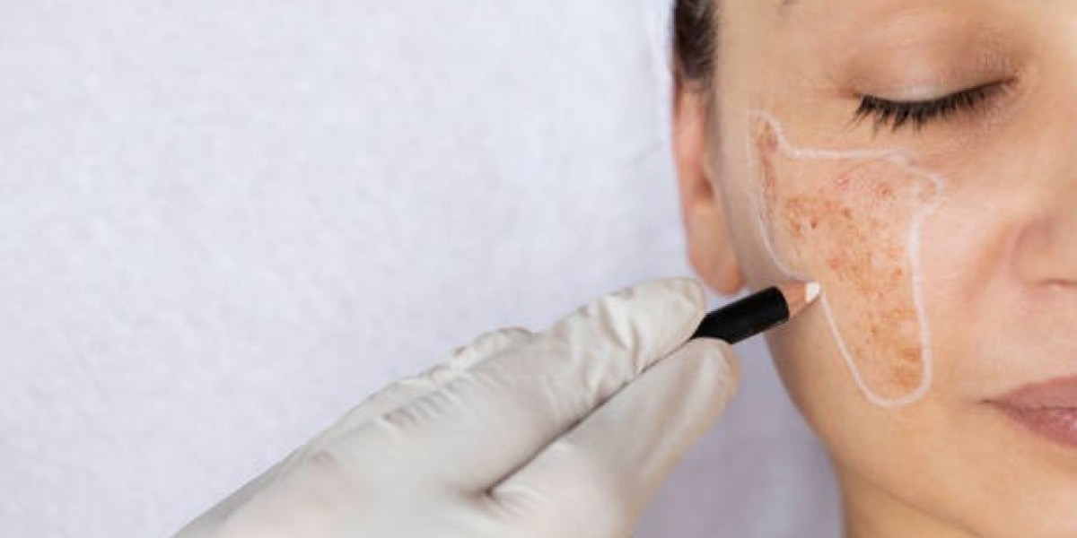 Natural Pigmentation Treatment in Dubai for Even Skin Tone