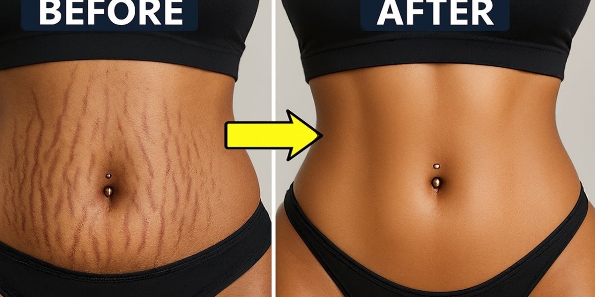 Aesthetic Stretch Mark Removal in Islamabad for Noticeably Better Skin