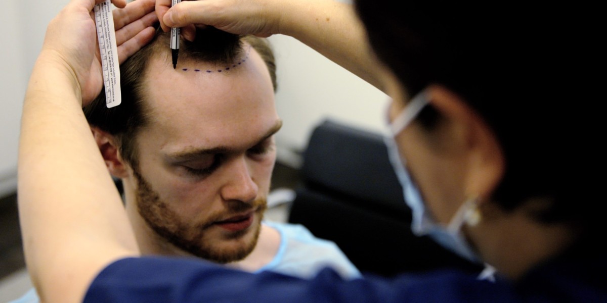 Crown Hair Restoration Cost in Islamabad Compared