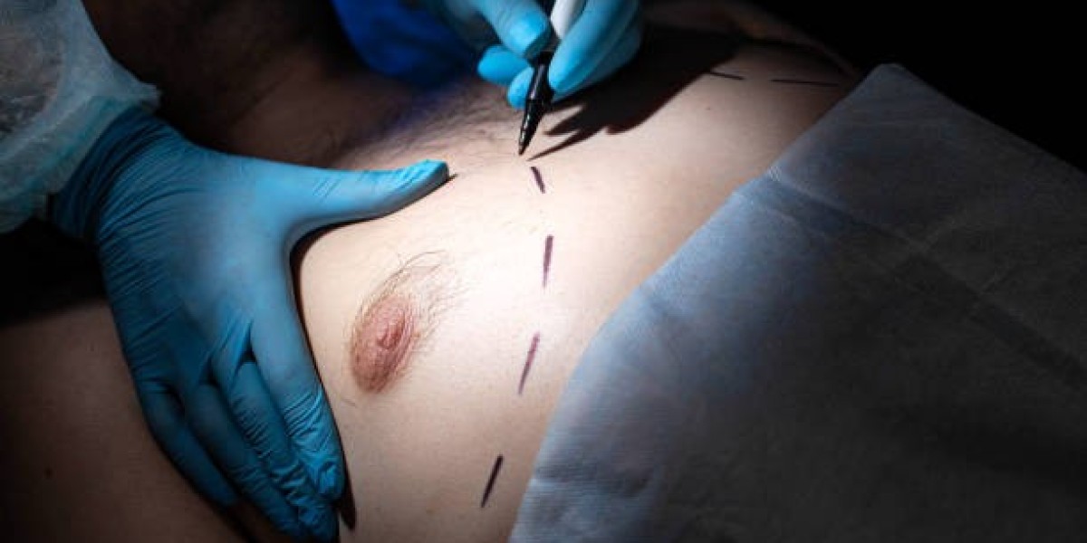 Gynaecomastia Surgery in Dubai: Managing Post-Surgical Healing