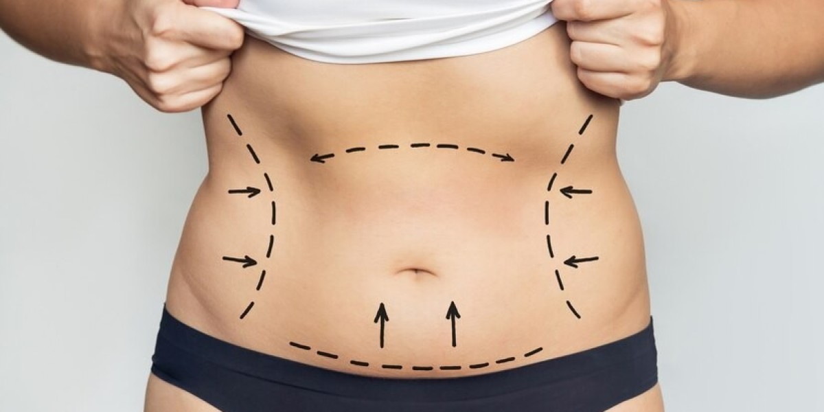 Liposuction Consultation Guide Questions You Should Ask