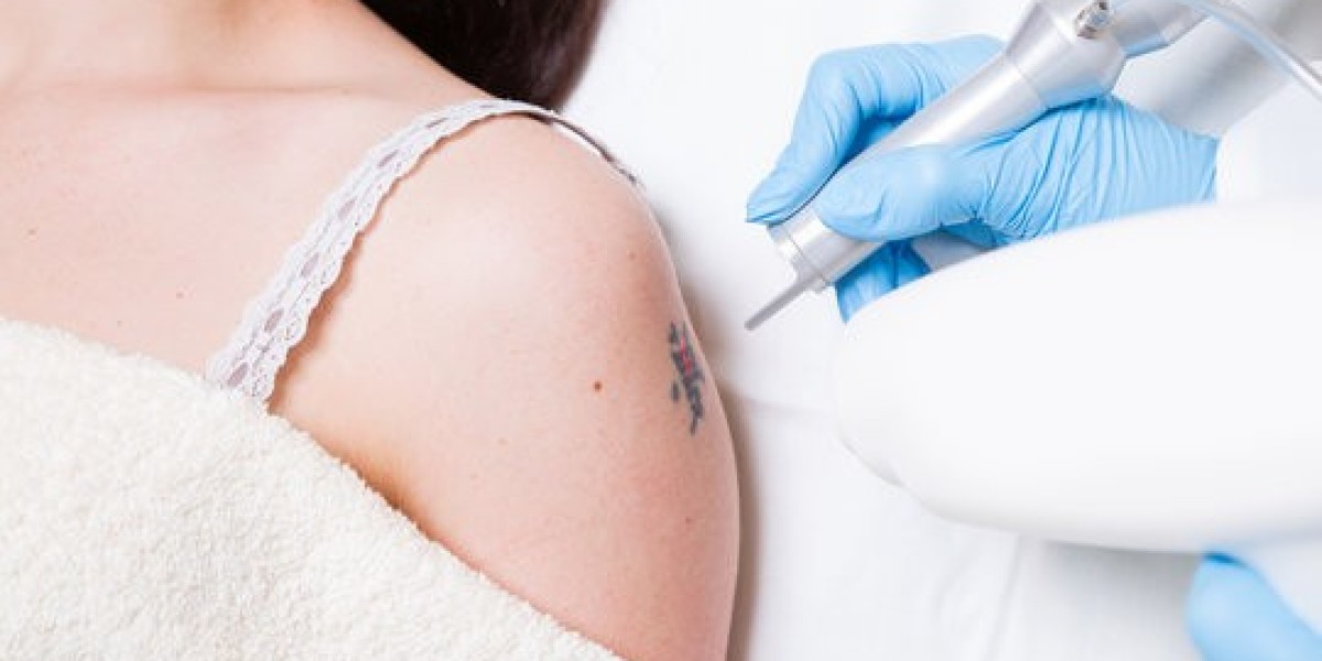 Strategic Multi-Session Tattoo Removal Using Picosure Device in Dubai