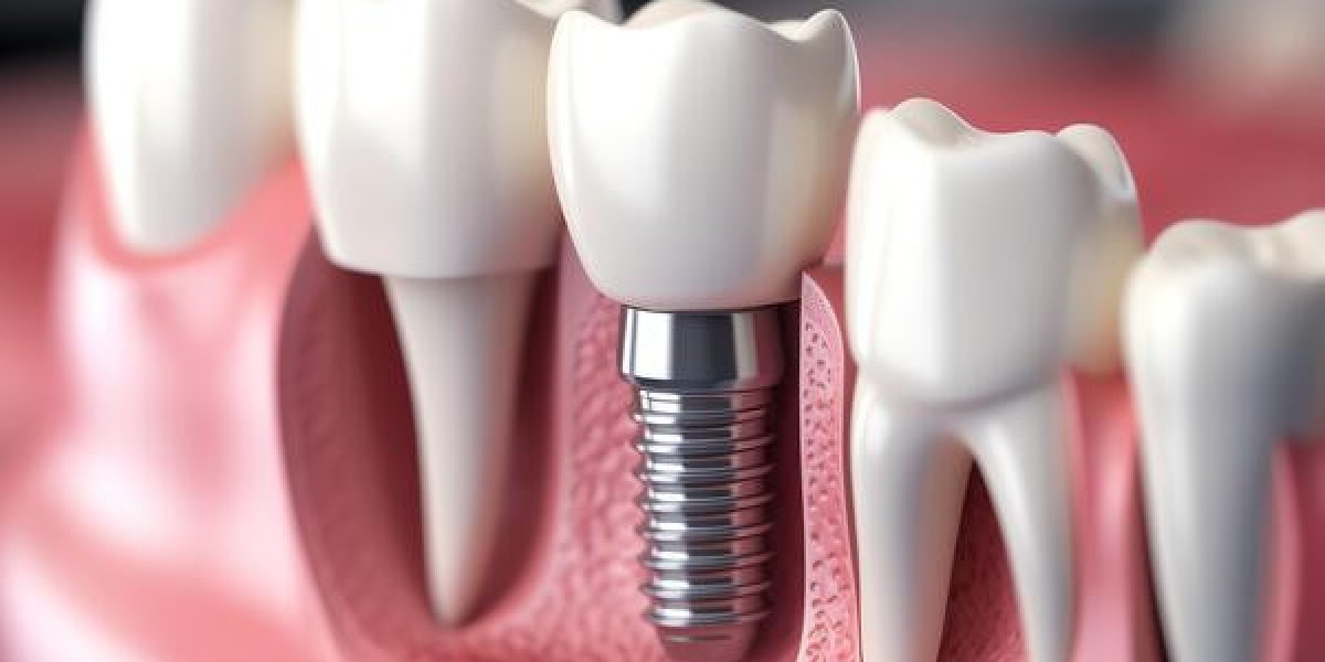 Teeth Implant Side Effects Most People Never Talk About