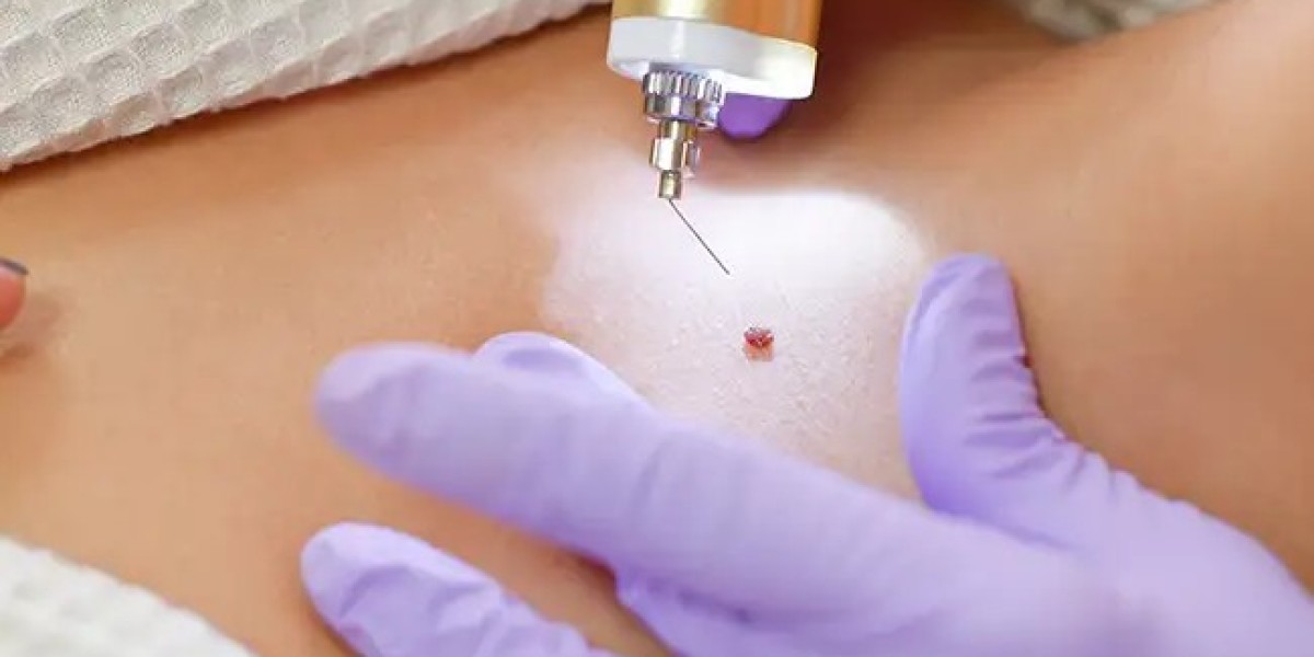 Wart Removal and Immune System Response Explained