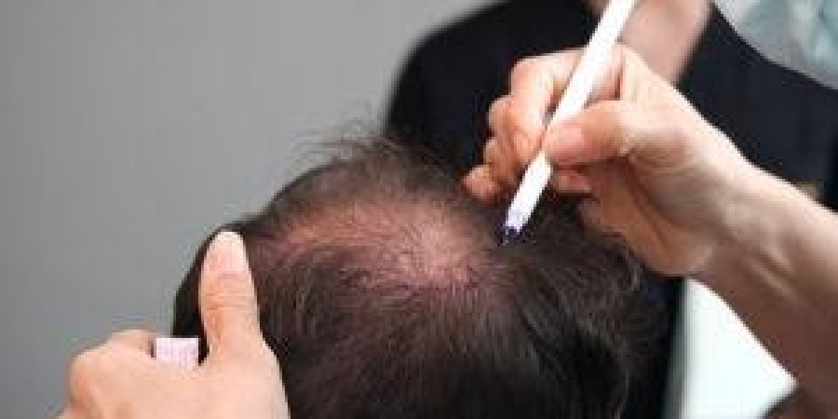 Hair Transplant and Hair Growth Cycle How It Works?