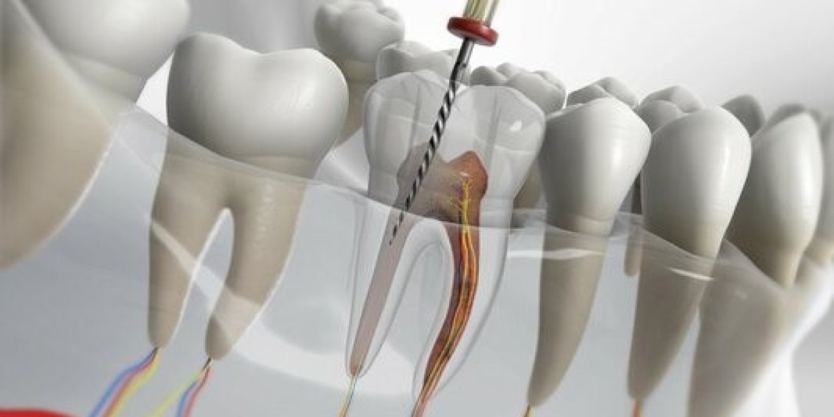 What is the normal charge for a root canal?