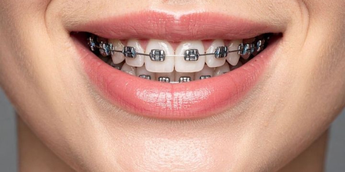 A Helpful Guide to Understanding Braces Cost and Treatment Options