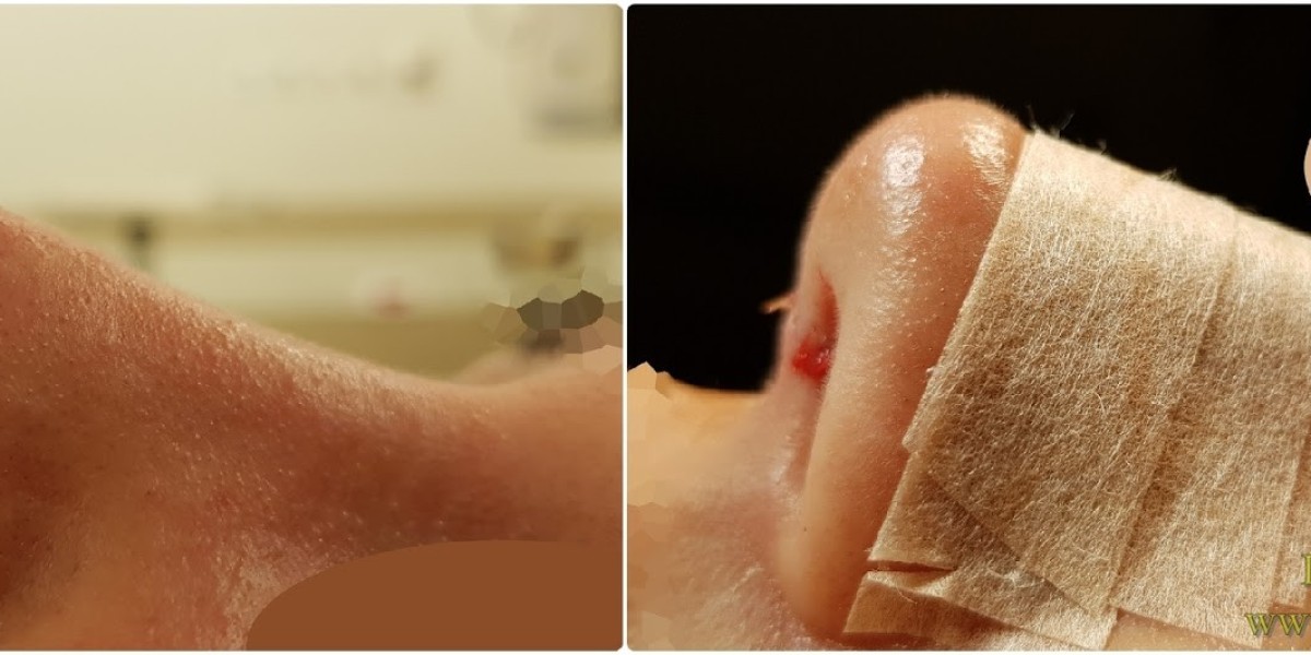 Nose Tip Plasty in Riyadh: Small Changes, Big Confidence