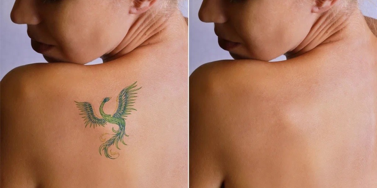 Picosure: Best Solution for Stubborn Tattoos in Islamabad