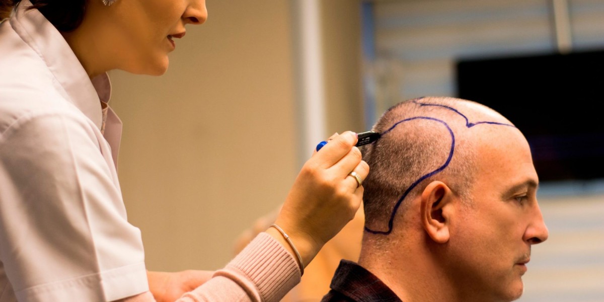 Direct Hair Implant in Islamabad Results You Can Expect