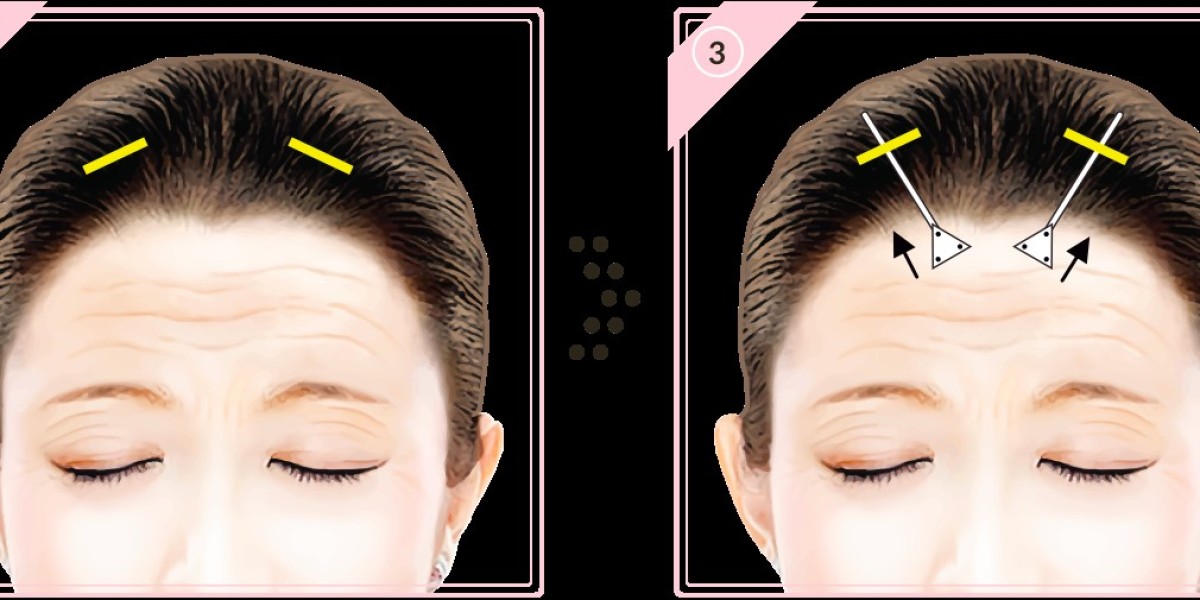 Managing Post-Operative Care for Brow Lift Patients in Riyadh