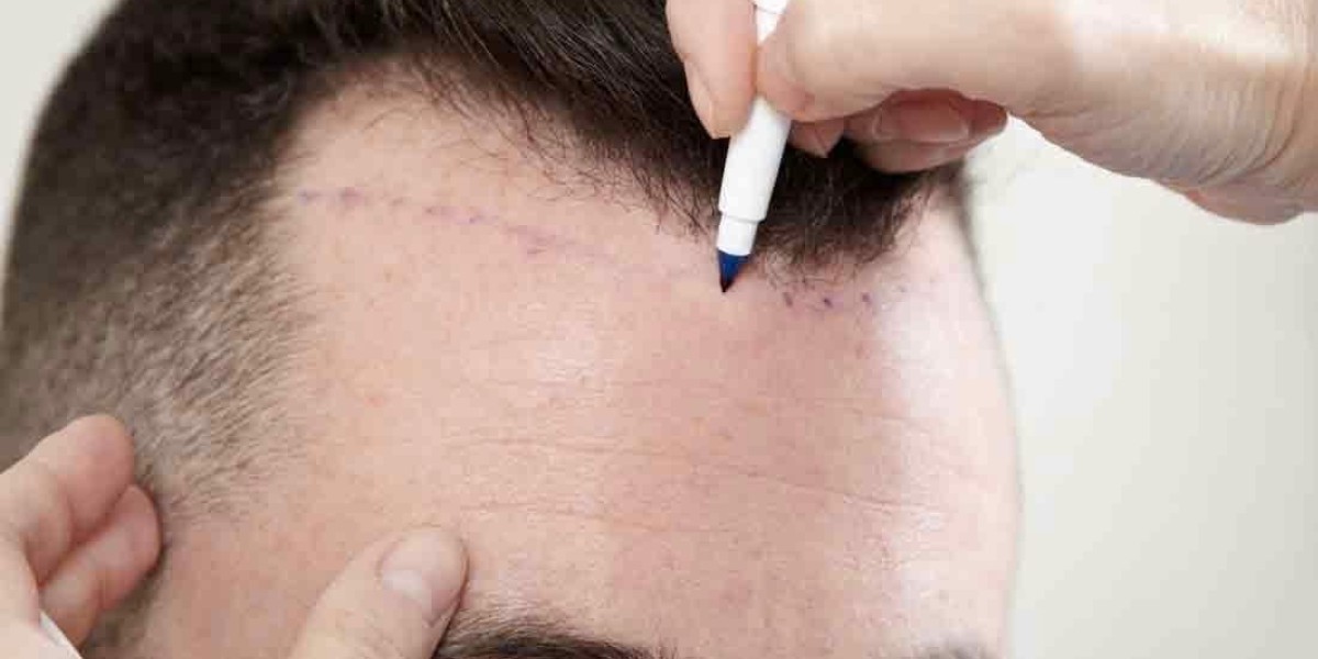Hair Transplant Price in India: Cost Factors, Options and Smart Planning Guide