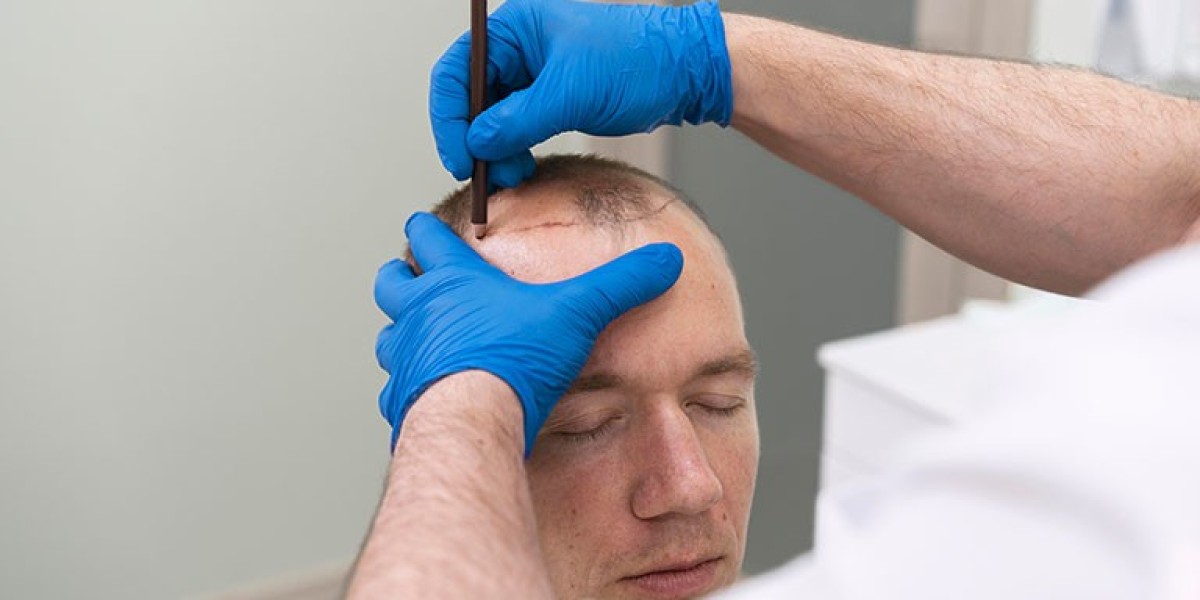 Hair Transplant Aftercare Essential Tips for Best Results