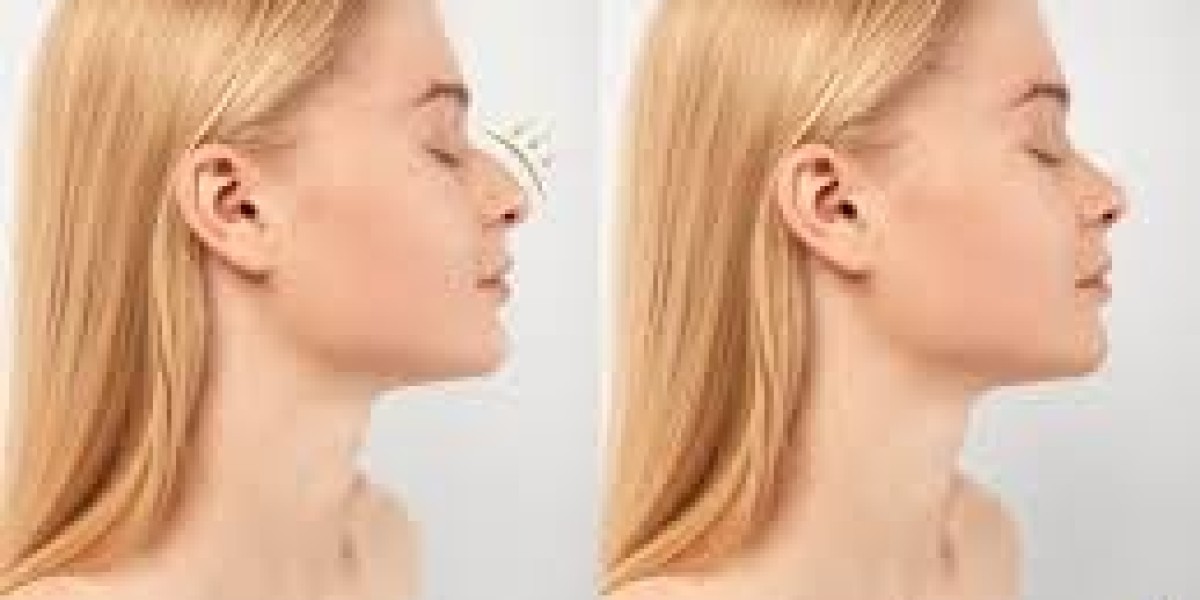 Rhinoplasty in Dubai: Revision Surgery Explained