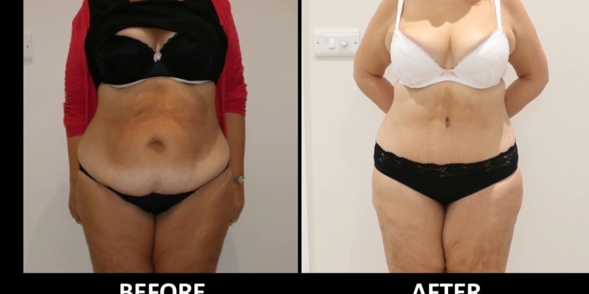 The Science of Radiofrequency: How BodyTite Transforms Your Figure