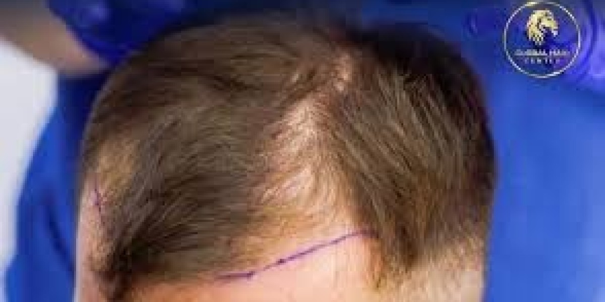 Hair Transplant in Dubai: Eligibility Guide for Candidates
