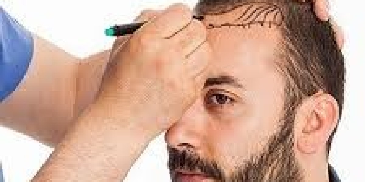 FUE Hair Transplant for Crown Baldness Full Coverage Solutions