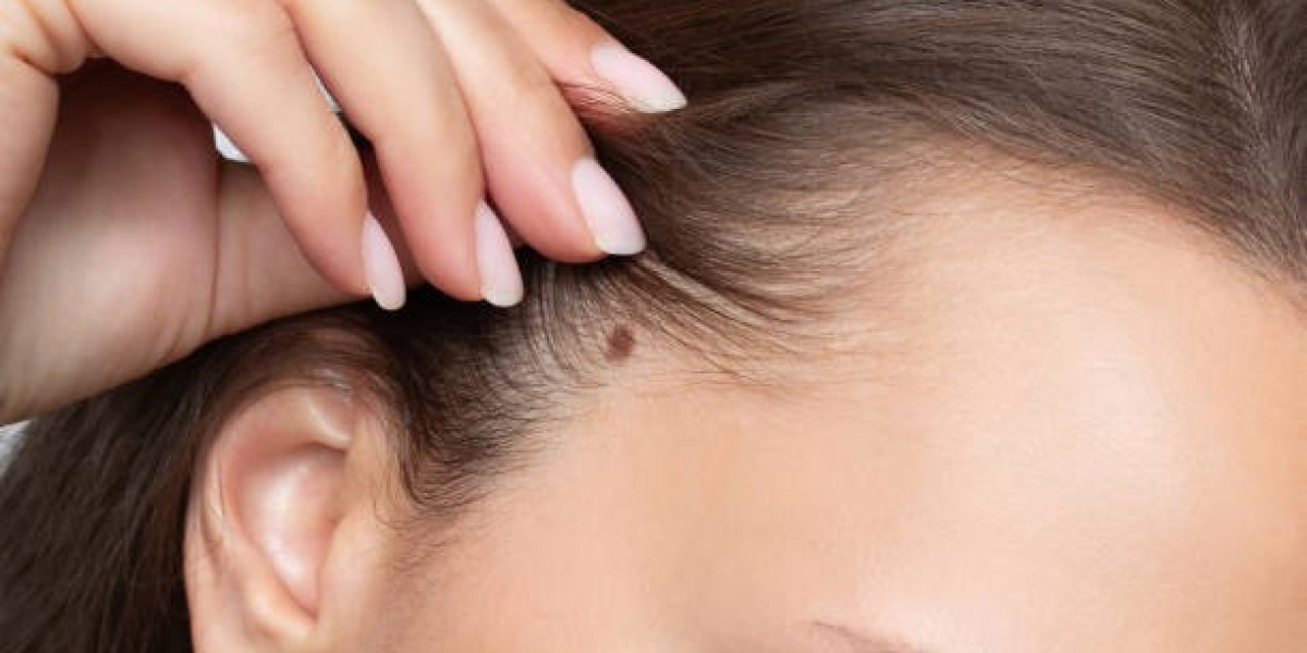 Mole Removal in Dubai: The Essential Aftercare Guide
