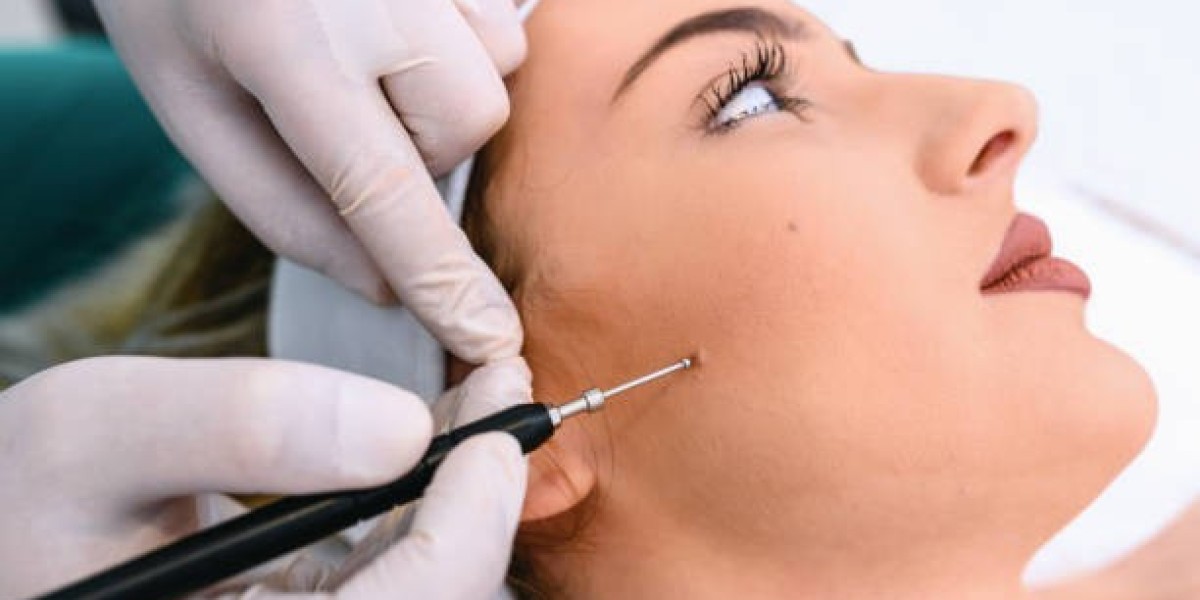 Mole Removal in Dubai: Long-Term Results & Maintenance | Tajmeels Clinic