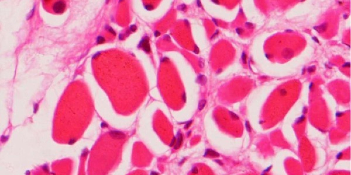 Diamond Blackfan Anemia Market: Advancing Rare Disease Treatment Through Innovation