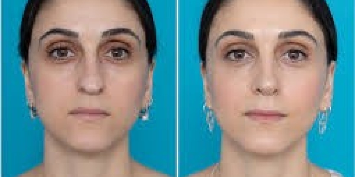 Blue Angel Poly Clinic: What UAE Full Face Fat Transfer Actually Feels Like