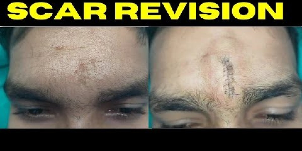 Pediatric Scar Revision: Gentle Surgical Care for Younger Patients