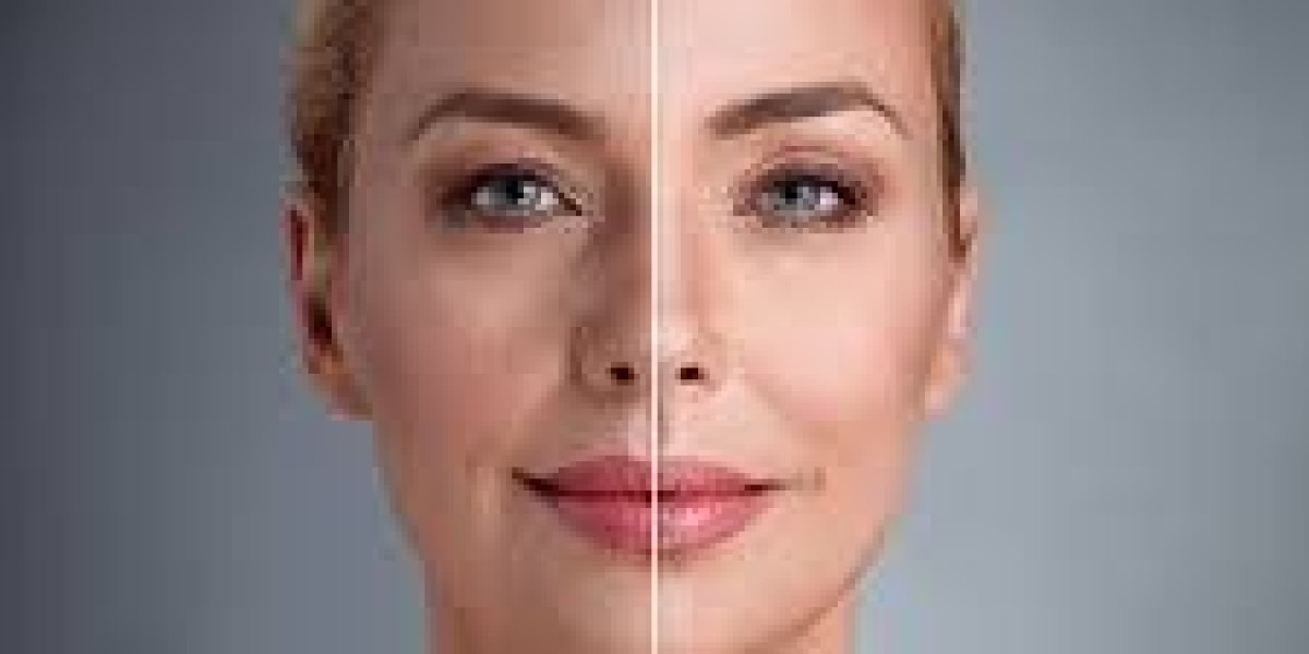Blue Angel Poly Clinic: What Deep Plane Facelift and Facelift Surgery UAE Actually Feel Like