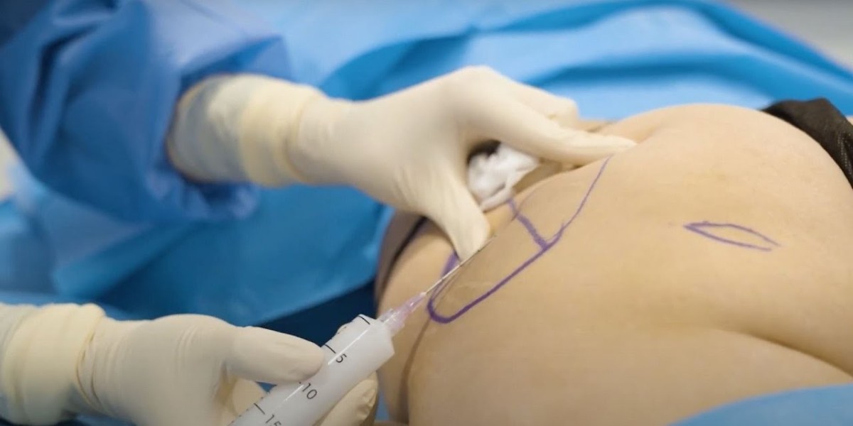 Customizing Your Curves: Tailored Buttock Enhancement Solutions in Riyadh