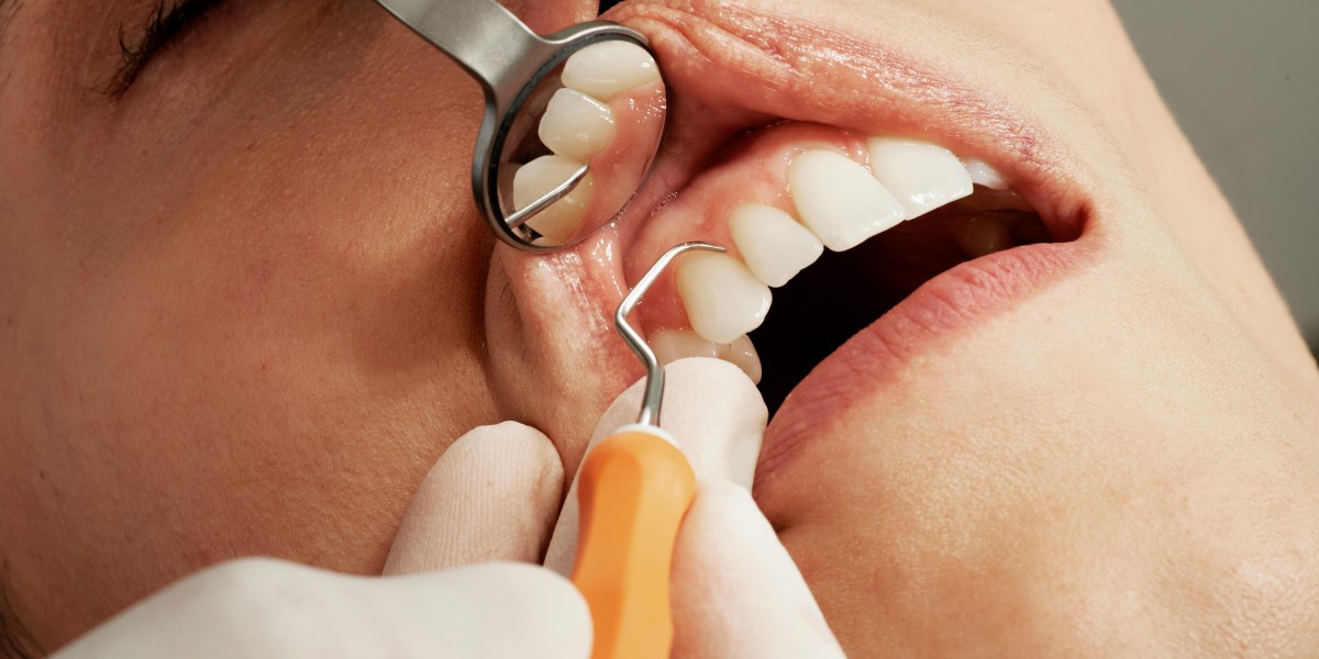 Veneers Hobart: A Modern Solution for a Perfect Smile