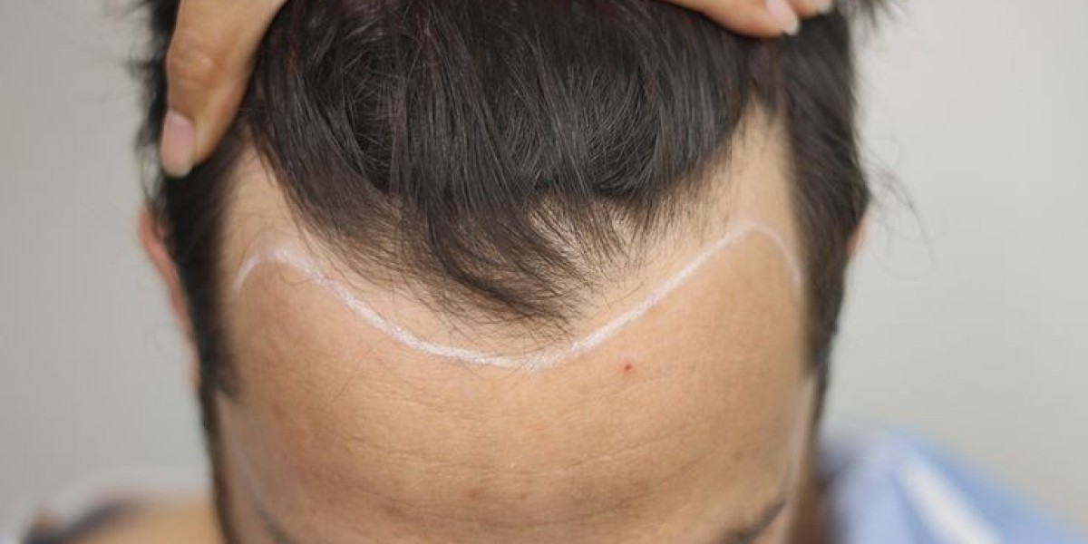 Hair Transplant What First-Time Patients Should Know?