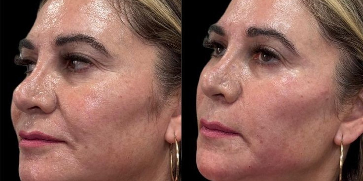 Liquid Facelift in Dubai Cost Factors Explained