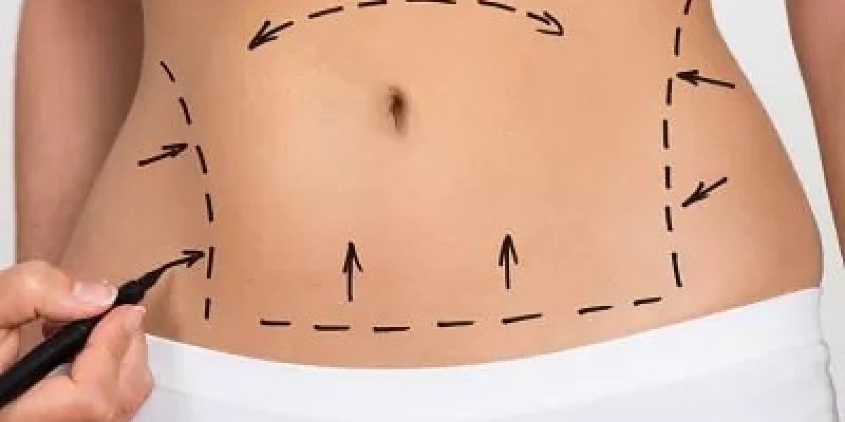 Liposuction for Stubborn Fat A Practical Solution