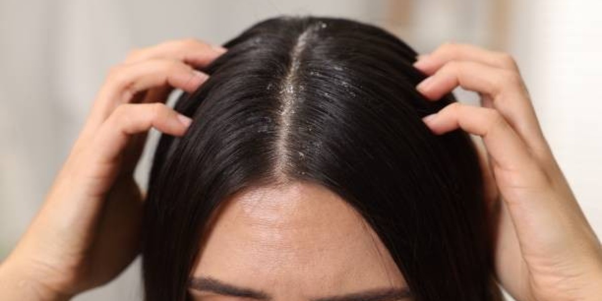 Dandruff Treatment in Dubai: Scalp Care for Hijab Wearers