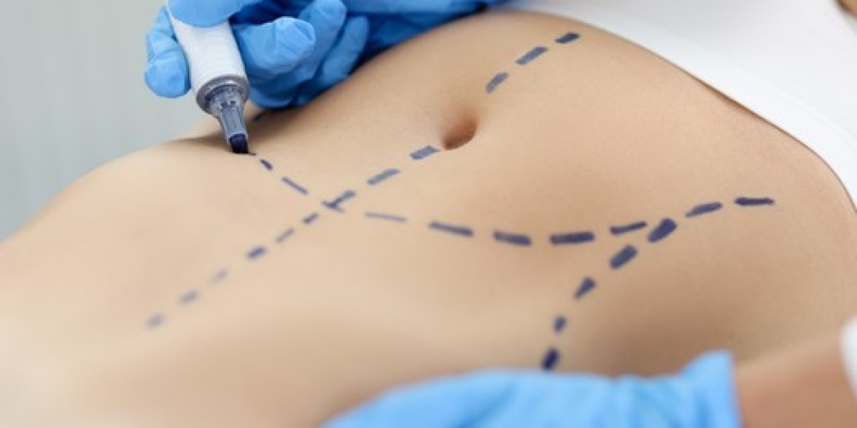 Vaser 4D for Post-Pregnancy: Restoring Core Definition Safely