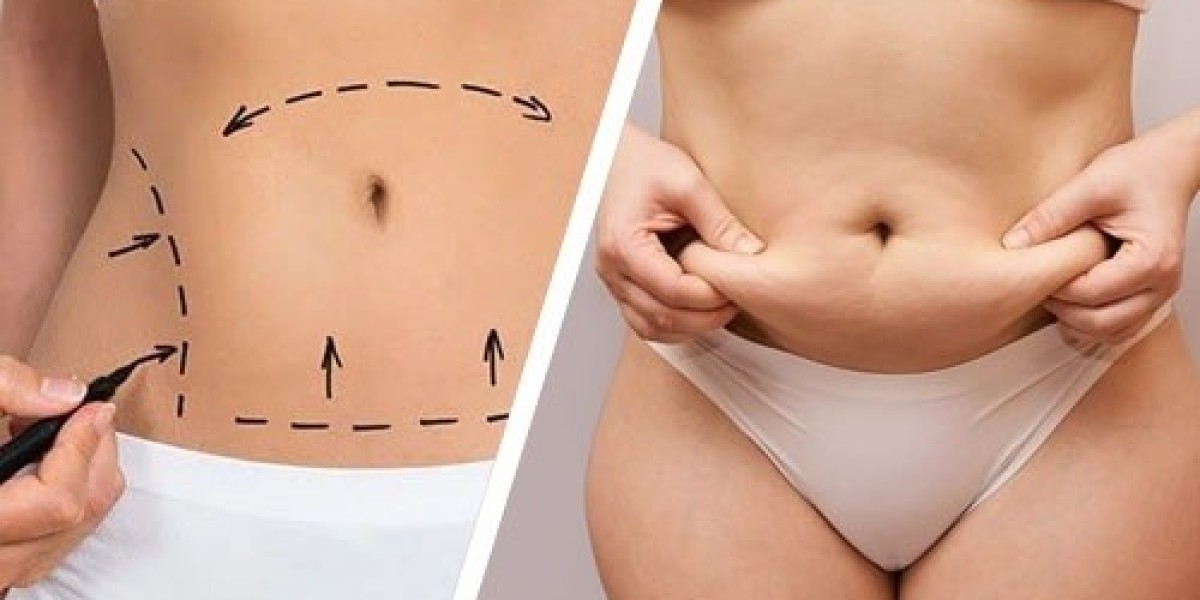 Types of Liposuction in Islamabad