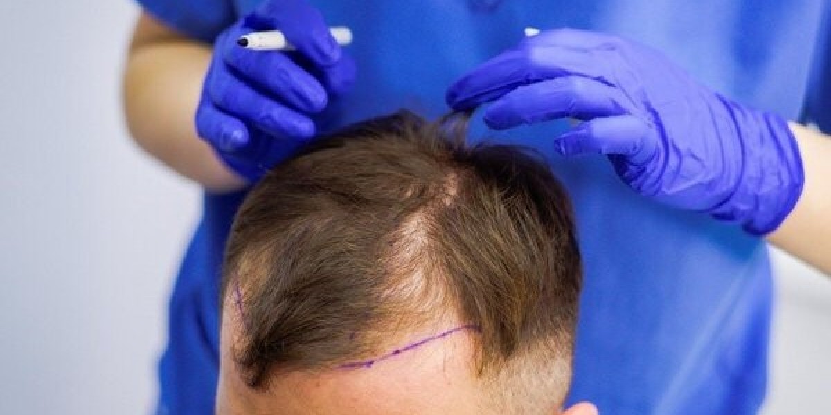 Hair Transplant Donor Area Explained and Its Importance