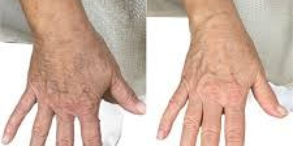 Hand Rejuvenation in Dubai for Healthy Skin