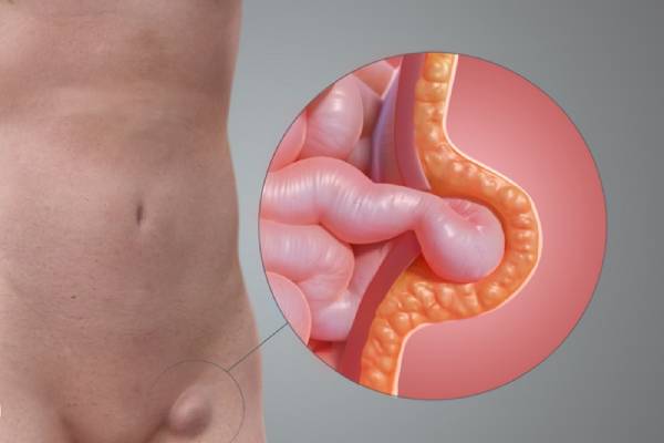 Femoral Hernia Treatment in Chennai - Dr. Srivatsan Gurumurthy - Hernia specialist in Chennai