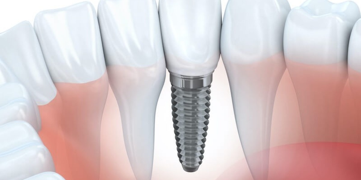 Dental Implants vs Bridges Key Differences Explained