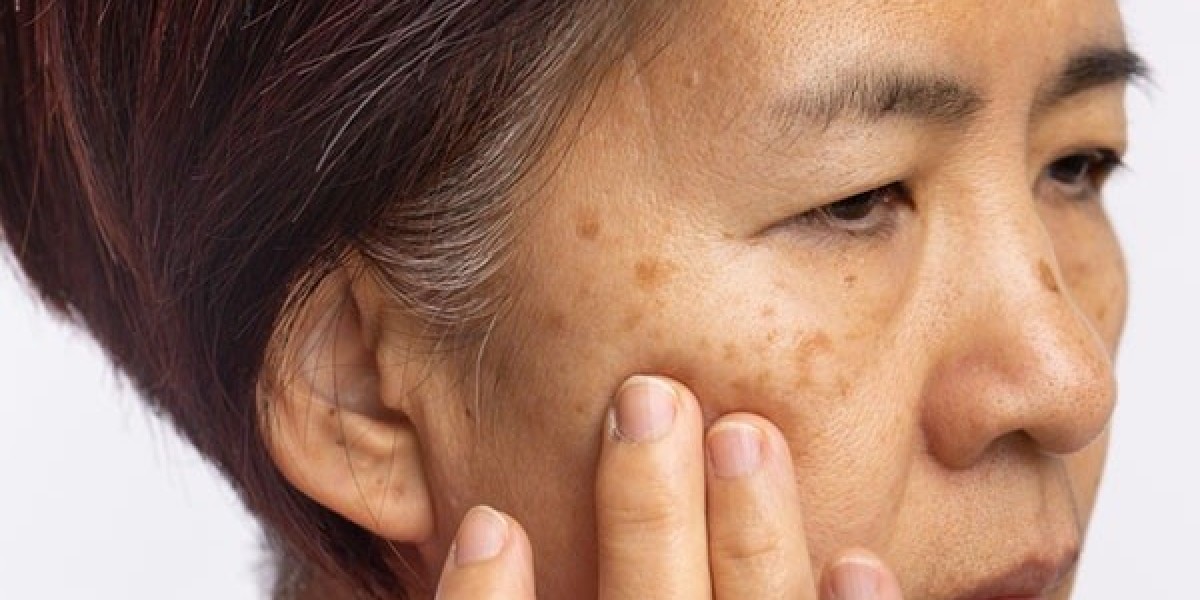 Melasma Treatment Market Growth Fueled by Rising Prevalence and Innovation in Skincare