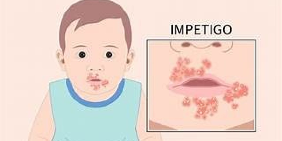 Impetigo Market Size, Share, and Forecast Analysis