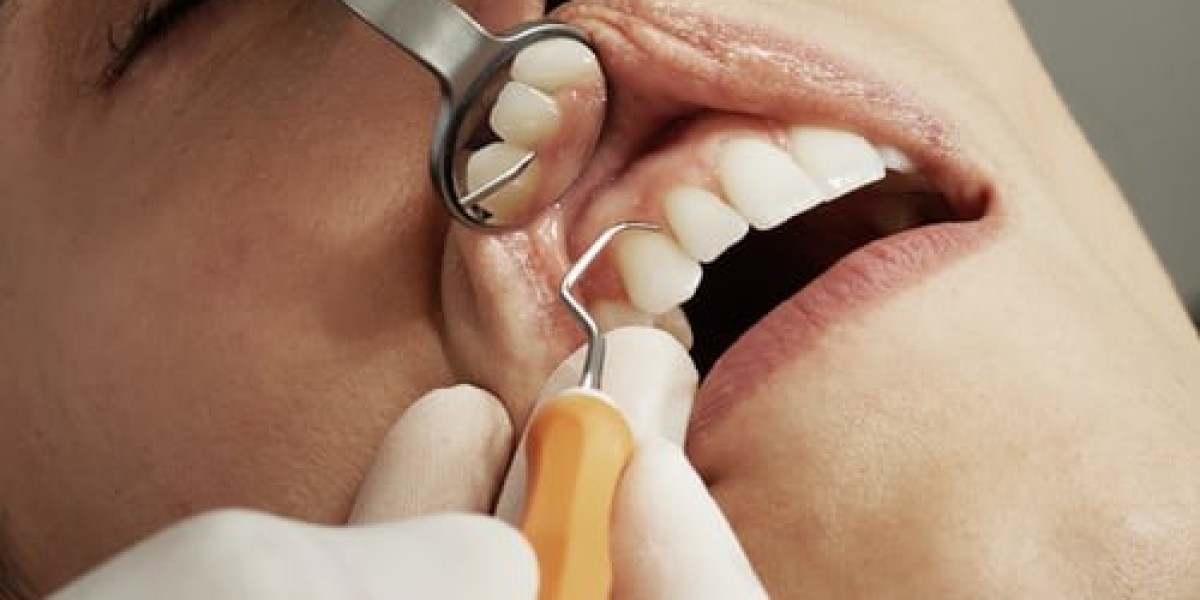 Zirconia Crown in Islamabad: A Modern Solution for Damaged Teeth